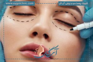 عمل بلفاروپتوز چیست؟ آشنایی با علائم رایج و مهم این بیماری