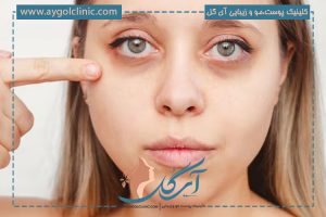 سیاهی دور چشم از چیست؟ + روش‌های خانگی و کلینیکی برای درمان