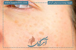 آیا درمان لک صورت با لیزر امکان پذیر است؟ + مزایا و عوارض