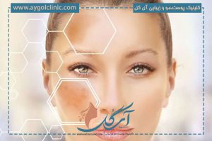 لیزر روشن کننده پوست: راهی نوین برای داشتن پوستی درخشان