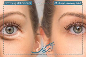 چین و چروک دور چشم: 4 علت اصلی آن + روش‌های پیشگیری و درمان موثر