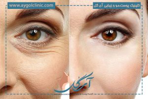 بررسی علت چروک شدن پلک چشم به همراه راهکارهای طلایی رفع آن