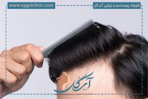ماندگاری کاشت مو | چقدر دوام دارد و چه عواملی تاثیرگذار است؟