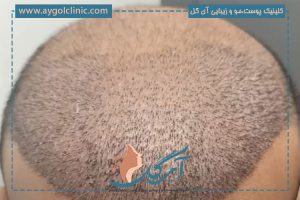 بعد از کاشت مو چه اتفاقی می افتد؟ مراحل رشد و مراقبت‌ها