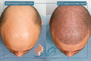 چه چیزهایی بعد از کاشت مو ضرر دارد؟ نکات مهم برای مراقبت