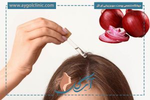 خوردن پیاز بعد از کاشت مو: چرا و چگونه؟ + 3 فایده مهم آن