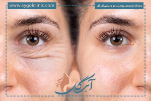 لیفت شقیقه بهتره یا بلفاروپلاستی؟ : کدام را انتخاب کنیم؟