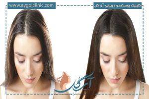 هزینه کاشت مو: عوامل مؤثر و راه‌های کاهش قیمت