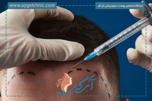 کاشت مو مصنوعی چیست و چه مزایا و معایبی دارد؟ + پروسه آن