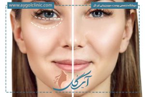 بررسی مصرف قرص برای پف زیر چشم به همراه علل ایجاد آن