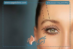 مزایای بلفاروپلاستی چیست؟ ۹ مزیت و محدودیت‌های جراحی پلک
