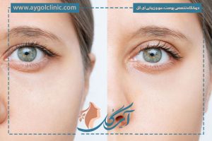 جراحی افتادگی پلک با بیمه و شرایط آن (مدارک + قوانین ۱۴۰۵) 🏥