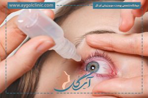 قطره چشمی برای رفع افتادگی پلک درمانی موثر یا بی‌فایده؟