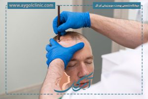 کاشت مو به روش HRT جایگزینی ایده‌آل برای کاشت موی طبیعی
