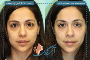 علت کبودی بعد از تزریق فیلر زیر چشم، همراه با مراقبت‌ها