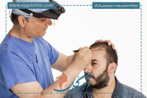 آشنایی با روش‌های کاشت مو برای ریزش موی ارثی