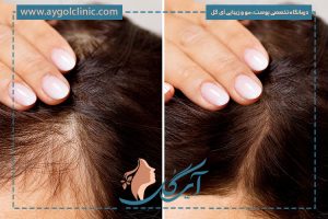 دلایل ریزش موی جلوی سر ، راهکارهای درمان و جلوگیری از آن چیست؟