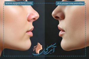 همه چیز درباره فیلر چانه؛ فرم‌دهی، برندها و مراقبت‌ها