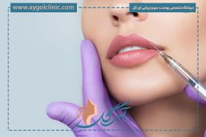 مراقبتهای بعد از تزریق ژل لب و تاثیر آنها در فرمگیری لب