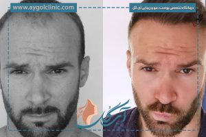 بررسی نتیجه کاشت مو بعد از ۳، ۶ و ۱۲ ماه همراه نکات مهم