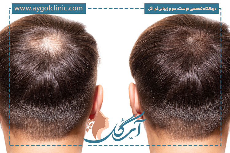 چه کسانی نمی توانند کاشت مو انجام دهند؟