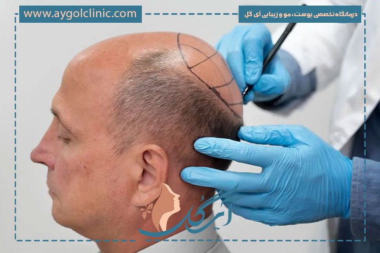 آیا کاشت مو خطرناک است؟