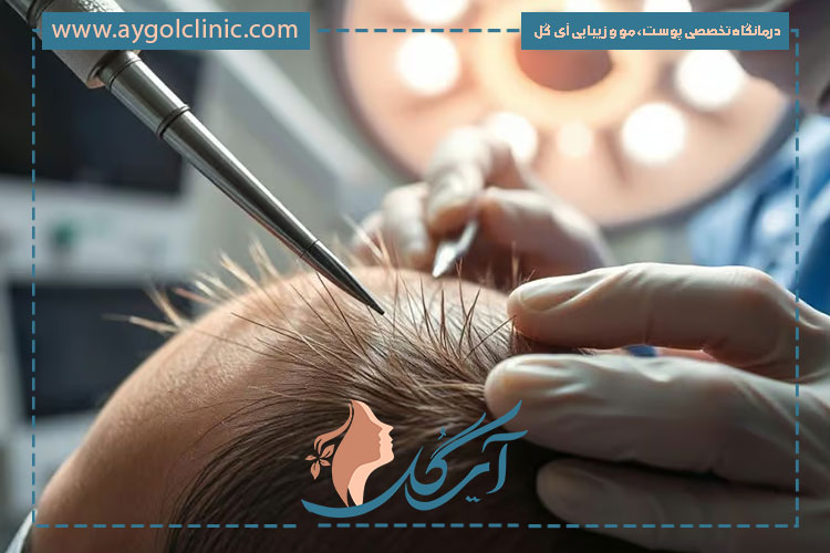 چه کسانی نمی‌توانند کاشت مو انجام دهند؟ محدودیت‌ها و موارد منع