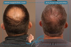 کاشت مو در فرق سر یا ناحیه ورتکس؛ هرآنچه باید بدانید