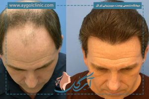 کاشت مو ناموفق | علائم، دلایل، درمان و راه‌های پیشگیری