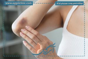 کبودی بعد از لیزر موهای زائد؛ دلایل، درمان و پیشگیری