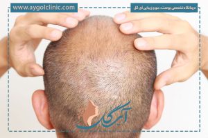 ۱۴ روز بعد از کاشت مو | همه چیز درباره مراقبت و تغییرات