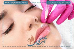 فرم‌دهی لب با ژل لب نورامیس؛ مزایا، ماندگاری و مراقبت‌ها