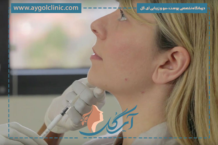 تزریق ژل چانه برای صورت گرد جهت ایجاد فرم متعادل و کاهش گردی صورت