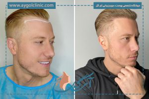 کاشت مو از ریش؛ بررسی روش‌ها، مزایا و مراقبت‌ها