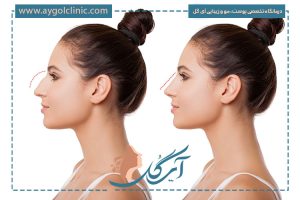 ماندگاری فیلر بینی و نکات مهم قبل و بعد از تزریق
