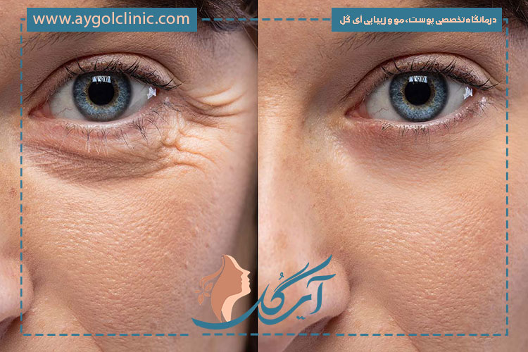 عوامل مؤثر بر ماندگاری بوتاکس ابرو و راهکارهایی برای افزایش دوام آن