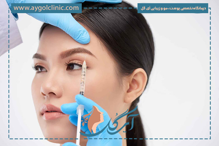 نقاط تزریق بوتاکس برای لیفت ابرو با هدف بالا بردن ابرو و فرم‌دهی طبیعی