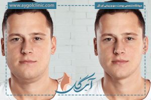 ساکشن غبغب چگونه است؟ بررسی روش، مزایا، عوارض و مراقبت‌ها