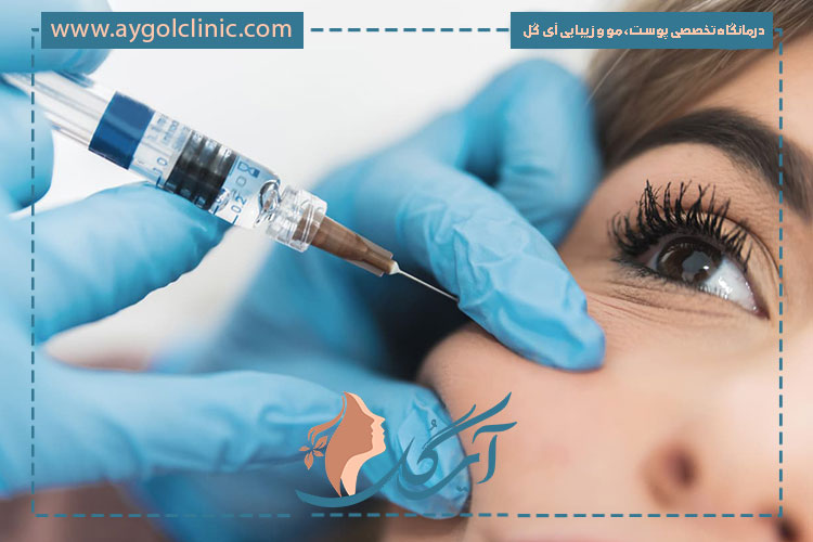 تزریق کات گونه روشی اصولی برای از بین بردن خطوط دور لب و چروک گونه