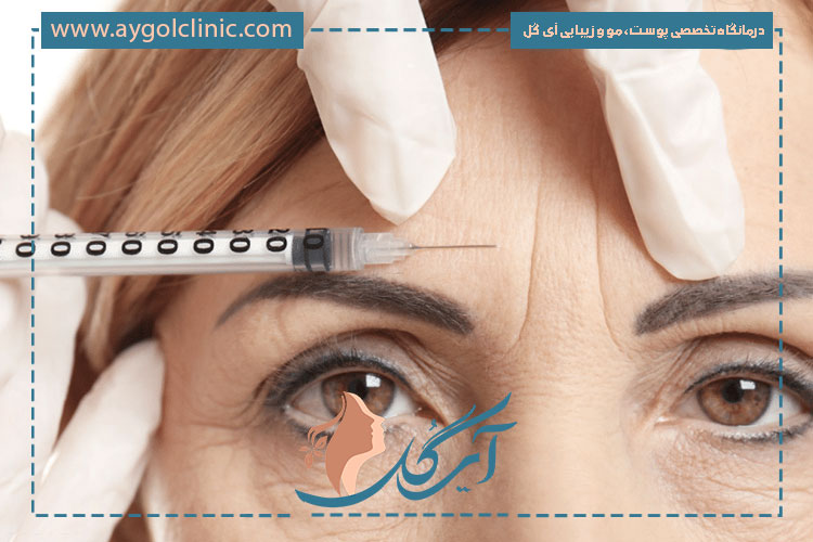 تزریق بوتاکس نابوتا توسط پزشکان متخصص و تجهیزات پیشرفته