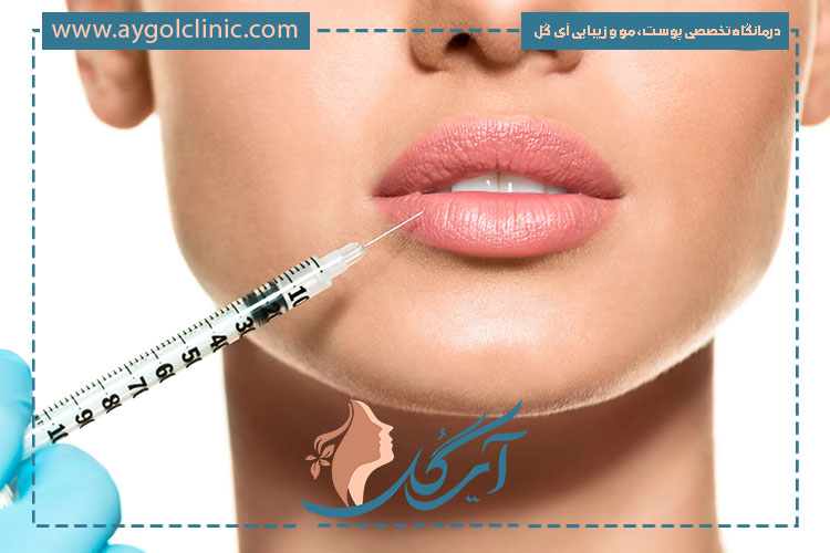 عوامل تاثیرگذار بر ماندگاری ژل لب نورامیس شامل نوع ژل، سبک زندگی و مراقبتهاست