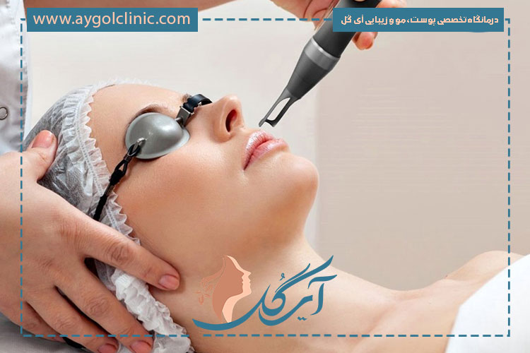 مدیریت پوسته ریزی بعد از لیزر co2 به نتیجه بهتر و کاهش عوارض کمک می‌کند