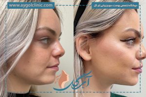 ماندگاری اندولیفت صورت چقدر است؟ + 5 عامل موثر آن که باید بدانید!