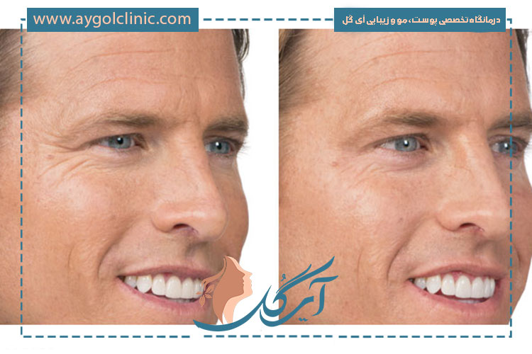 تزریق بوتاکس برای کاهش چینوچروکهای صورت و افزایش شادابی و جوانی پوست