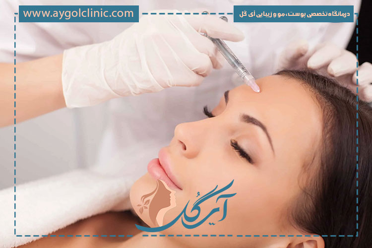 درمان تعریق بیشازحد با بوتاکس روشی موثر برای کاهش فعالیت غدد عرق بدن است.