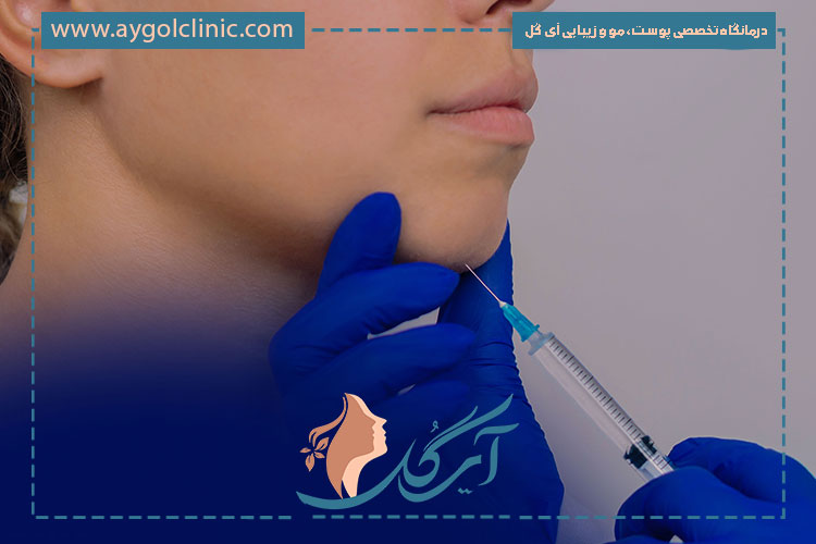 بوتاکس چانه سنگفرشی روشی موثر برای کاهش ناهمواری‌ها و بهبود ظاهر طبیعی پوست است.