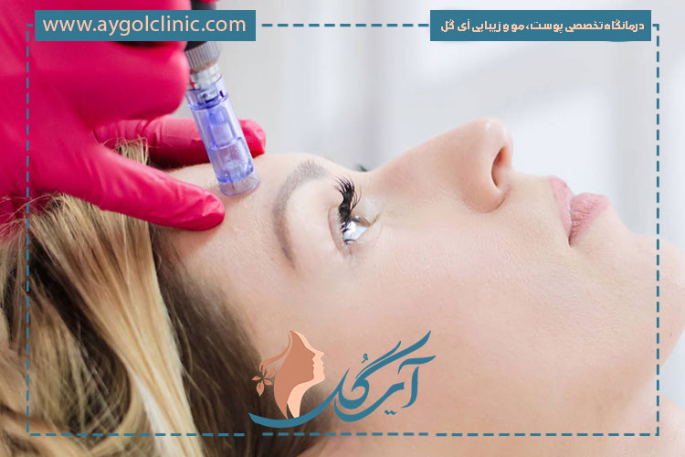 مراقبت‌های لازم برای افزایش تاثیر بوتاکس