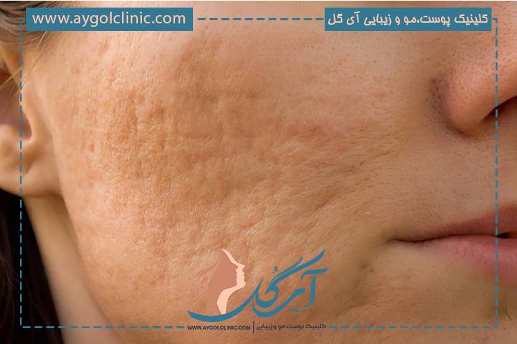 کاربرد سابسیژن و ترکیب با روشهای زیبایی دیگر