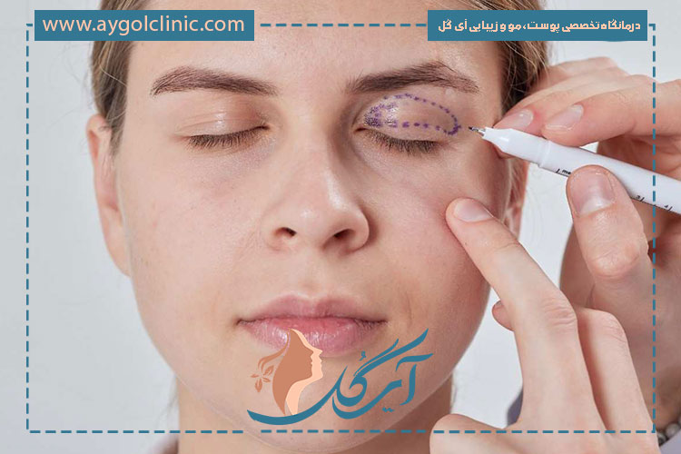 توصیه‌های غذایی بعد از بلفاروپلاستی برای کاهش دوره نقاهت
