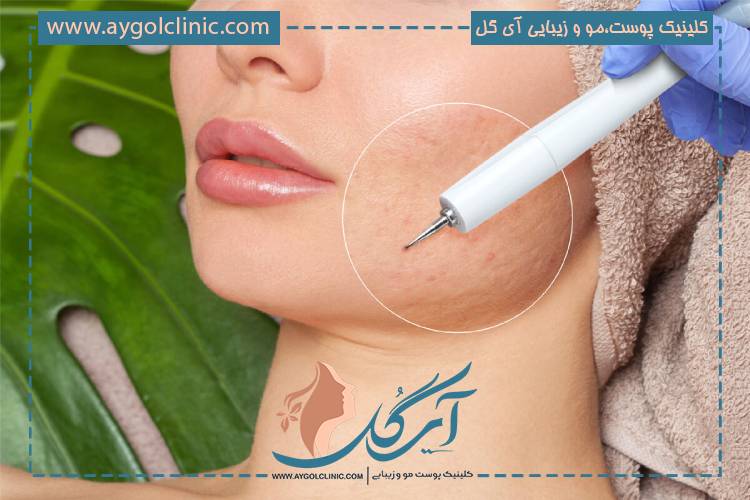 سابسیژن صورت و رفع جای جوش با تکنیک حرفهای